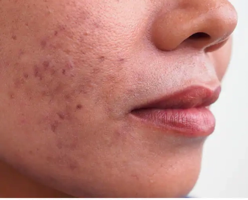 Scars and Acne Scars Melbourne - Scars and Acne Scars donvale