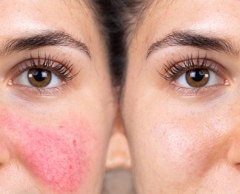 Rosacea donvale, Rosacea doncaster, Rosacea Melbourne